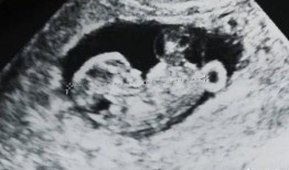 娱乐圈b超单子爆料